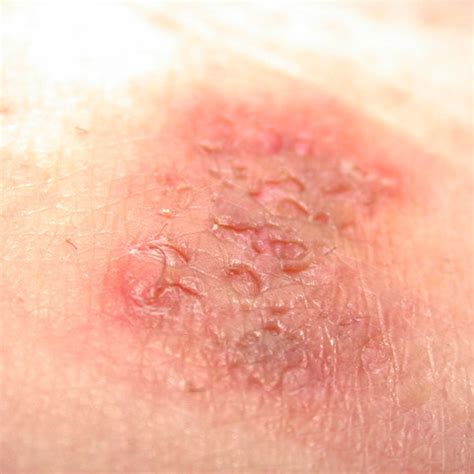 reddit hidradenitis suppurativa